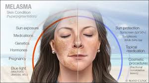 Image result for Melasma