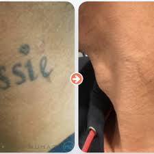 Simply laser hair removal is one of the outstanding laser hair removal specialists in london, based in between holborn and tottenham court road tube stations. Top 10 Best Laser Hair Removal In Mcdonough Ga Last Updated July 2021 Yelp