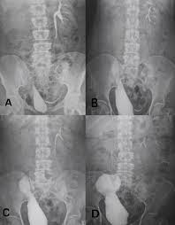 Image result for Intravenous Pyelogram