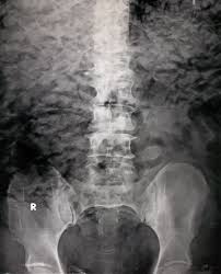 Surgical Emphysema Crumpled Paper Appearance Radiology Case Radiopaedia Org Radiology Radiology Imaging Crumpled Paper