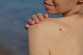 Skin Tags Facts Causes Symptoms Types Treatment Prevention Factdr