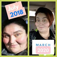 Keto improving skin health and aging