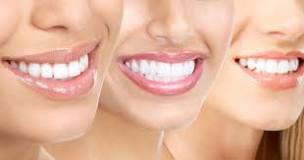 What Is Smile Design Dentistry? (Your Smile Makeover Guide)