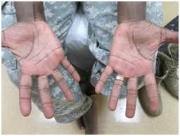 If you're wondering if adults can get hand, foot and mouth disease, the short answer is yes. Coxsackie A6 Infection Atypical Hand Foot Mouth Disease In The Us Military A Case Series