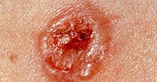 The pimple also may go away and come right back in the same spot, and it won't have pus when you squeeze it, wattenberg noted. Skin Cancer Or Mole How To Tell Cbs News