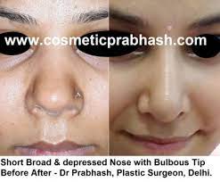 The huge variation in cost in india depends upon the choice of hospital and the choice of city. Rhinoplasty India Best Nose Job Surgery Cost Delhi Rhinoplasty Before After