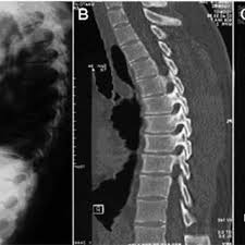 During period #1, a fracture has not formed and wellbore storage controls the pressure behavior. Pdf Sternal And Vertebral Fractures A Well Known Association Usually Overlooked Review Of Six Clinical Cases