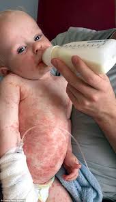 Hsv infection in newborn babies can be very severe and can even cause death. Toddler Nearly Died After Catching Herpes From A Kiss Daily Mail Online