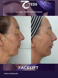 draprada #dramaiteprada #tess #aestheticinovation #scaffold  #teslift_official #tessscaffold #nonsurgicalfacelift #beyondaesthetics