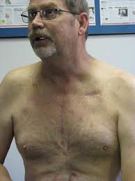 Second chance at life: A Kearney man's heart transplant experience at UNMC