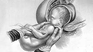 Image result for Breech Presentation