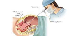 Does insurance cover laparoscopy in india. What Is Laparoscopy Surgery Cost In India Top 20 Hospitals Surgeons