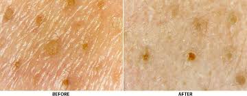 Many people think pore strips are a safe way to remove blackheads and treat large pores, but here's what you need to know before you plaster . Best Pore Strips For Nose Chin Forehead Do They Really Work