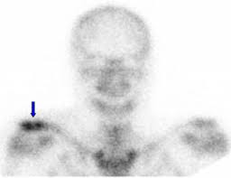 Image result for Osteomyelitis Bone Scan