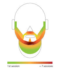 I Made Chart To Explain Where Laser Hair Removal Is Working