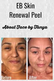 Client of Esthetician Tanya McCutcheon from About Face By Tanya located in  Seabrooke, Texas. Her client is absolutely delighted at the transformation  of her skin.
