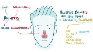 Allergic Rhinitis A Neglected Disease Sharing Symptoms With Covid 19 Here S How To Identify It Technology News Firstpost