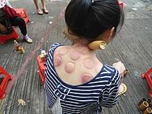 These marks or bruises are nothing serious and should not be a matter of concern. Cupping Therapy Wikipedia