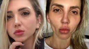 Como a fisiologia hormonal pode interferir na saúde bucal e na harmonia da face. Influenciadora Se Arrepende De Bichectomia Minha Cara Caiu Portal Atualizado