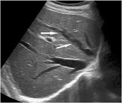 Budd Chiari Syndrome An Update On Imaging Features Clinical Imaging