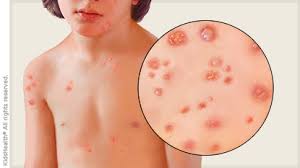 These rashes are even more common in patients who are more severely ill, because of blood vessel blockage in the skin. even though the idea of rashes and purple toes may frighten some, experts, like okoye, say the best thing you can do is protect yourself from becoming infected in the first place. Chickenpox For Parents Nemours Kidshealth