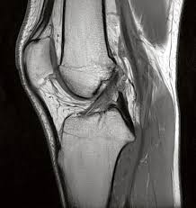 Magnetresonanztomographie Mri