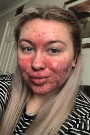 Těžká forma akné nutí dívku trávit dvě hodiny denně líčením