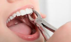Nhổ răng - Nha Khoa Quốc Tế BIK