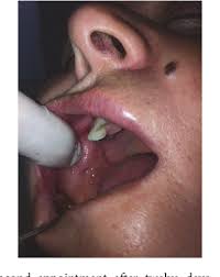 3 yrs ago, dry lip, split and bled. Figure 3 From Sclerotherapy Of Intraoral Superficial Hemangioma Semantic Scholar