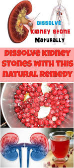 Natural Remedy For Dissolving Kidney Stones That Really Work Natural Remedies Natural Remedies Health Remedies