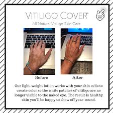 Van wikipedia, de gratis encyclopedie. Celebrities With Vitiligo