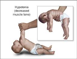 Neurological Phenotypes For Down Syndrome Across The Life Span Semantic Scholar