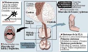 La esclerosis lateral amiotrófica (ela) es una enfermedad degenerativa de tipo neuromuscular. Enfermeria De Ciudad Real