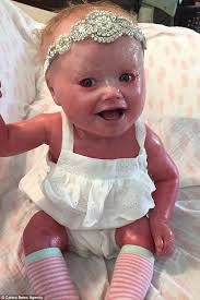 Genetic and rare diseases information center. New York Mother Cares For Her Baby With Harlequin Ichthyosis Express Digest