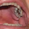 This article will cover the most common causes of a hard bump on the roof of your mouth. 1