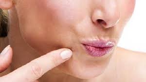 Mereka biasanya memiliki warna yang sama dengan kulit, tetapi mereka dapat berpigmen juga. Acanthosis Nigricans Punca Dan Rawatan