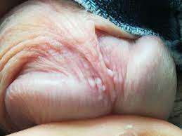 Tyson Glands Or Warts? Conflicting Diagnosis! (Pics) | Penis Disorders |  Forums | Patient