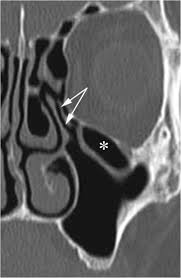 They are extramuralethmoidal air cells that extend into the inferomedial orbitalfloor and are present in ~20. An Additional Challenge For Head And Neck Radiologists Anatomic Variants Posing A Surgical Risk A Pictorial Review Insights Into Imaging Full Text