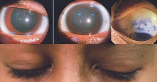Image result for nevus sclerae