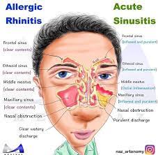 Pin By Madeleine Collier On Medical Nasal Obstruction Maxillary Sinus Sinusitis