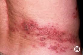 Image result for herpes zoster