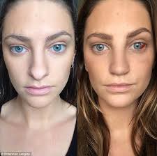 Rhiannongetsrhino Blogger Shares Her Diary Of A Nose Job Rhinoplasty Nose Job Nose Surgery