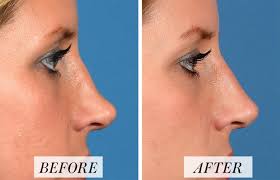 Time traveler for nose job. What Is Nonsurgical Rhinoplasty Risks And Results Of Nose Fillers Allure