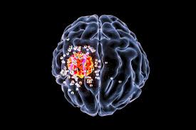 Cancer is the astrological sign, the fourth indication of the zodiac. Deadly Brain Cancer Stopped With New Compound