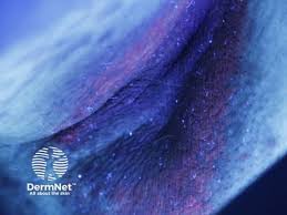 Image result for Erythrasma