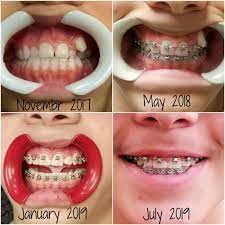 Brackets are the small metal or ceramic devices that hold the wires in place on your teeth. What To Expect Almost Done With Braces A Mom S Take