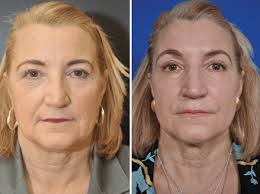 Green tea also helps to reduce sagging skin around mouth and to get rid of botox in your 30s. Treatment Suggestions For Deep Marionette Lines Jowls Dr Dean Kane