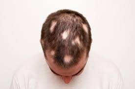 Sunflower seeds are rich in vitamin b5 (known as pantothenic acid), which helps with blood flow to your scalp and hair growth. Alopecia Areata Causes Symptoms And Treatment