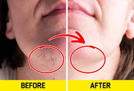 Take a glass bowl and in it, add three tbsp of sugar, one lemon juice and honey and mix well all. 9 Simple Ingredients To Get Rid Of Facial Hair At Home