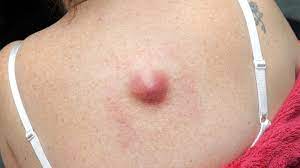13.04.2017 · skin cancer on legs. What Is A Skin Lump Symptoms Causes Diagnosis Treatment And Prevention Everyday Health